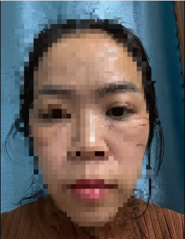 Lam-dong-chi-tiet-gay-phan-no-vu-chong-ru-nhom-nguoi-chan-duong-danh-vo-den-muc-phai-nhap-vien-4
