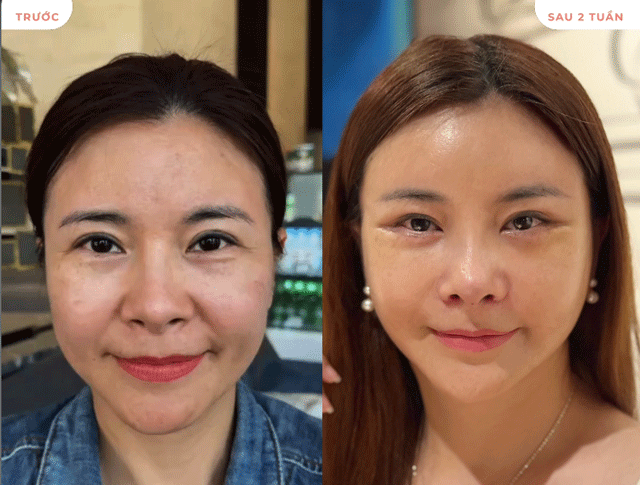 Dien-vien-kim-oanh-vo-anh-nui-co-tuyen-bo-gay-sot-sau-khi-cong-khai-viec-phau-thuat-o-tuoi-50