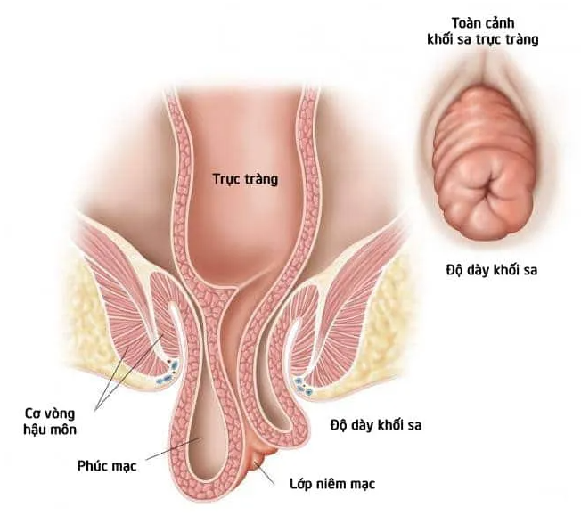 Ruot-nguoi-dan-ong-loi-ra-13cm-khi-ngoi-toilet-luot-dien-thoai-2-tieng-nguyen-nhan-nhieu-nguoi-mac-phai