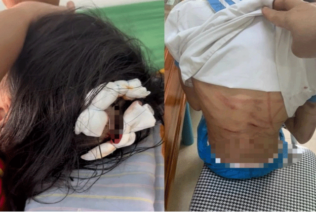Tinh-hinh-moi-nhat-ve-tinh-hinh-suc-khoe-be-gai-bi-cha-duong-danh-nhieu-vet-thuong-den-muc-khong-the-dem-1