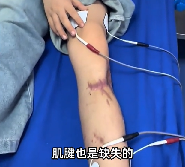 Cau-be-7-tuoi-bi-3-con-cho-can-vien-tai-bi-dut-hoan-toan-dut-co-nach-va-dut-roi-bap-chan-trai-4