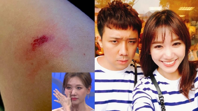 Tin n&oacute;ng trưa 3/5: Hari Won đau đớn v&igrave; bị Trấn Th&agrave;nh 'qu&yacute;nh' bầm dập ảnh 1