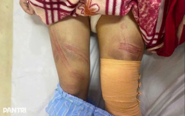 nu-sinh-lop-7-nhap-vien-vơi-nhieu-vet-bam-tren-co-the