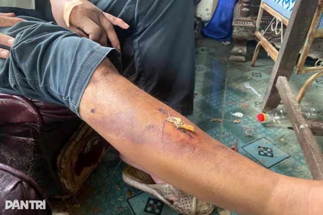 vet-thuong-tren-chan-nguoi-dan-ong-bi-hoc-sinh-danh