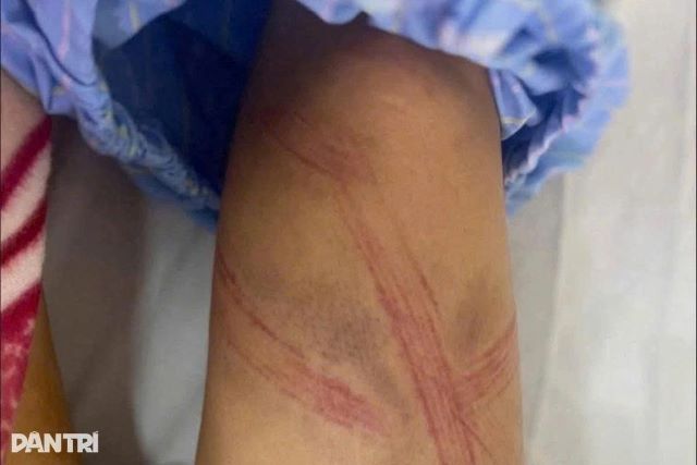 nu-sinh-lop-7-bi-bo-bao-hanh