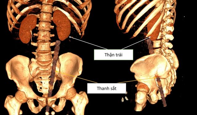 thanh-sat-choc-thung-hau-mon