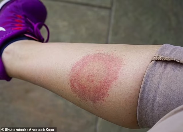 74828807-13642729-Lyme_disease_can_be_tricky_to_diagnose_a_tell_tale_bulls_eye_ras-a-10_1721210395158_11zon