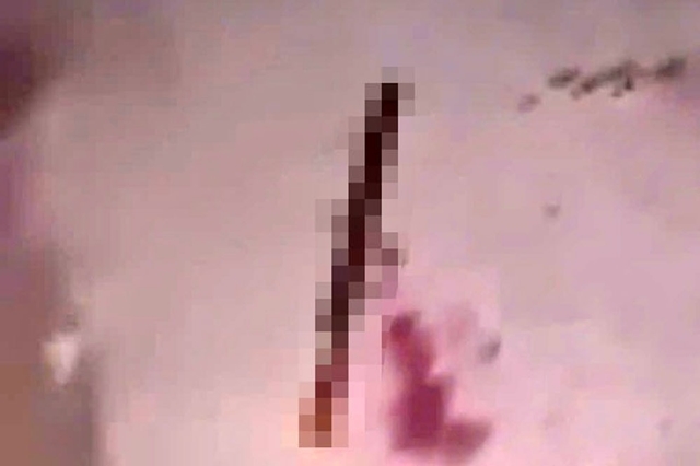 thanh-nien-bi-chem-dut-lia-ban-tay-1