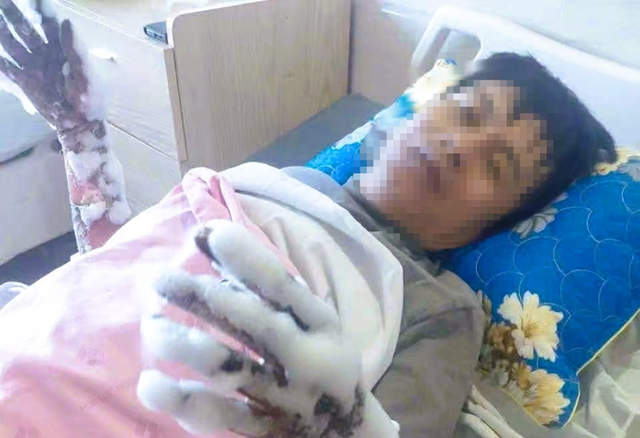 nam-cong-nhan-bi-bong-1