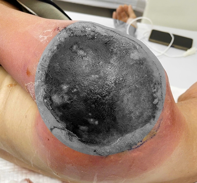 dap-la-chua-chan-thuong-2