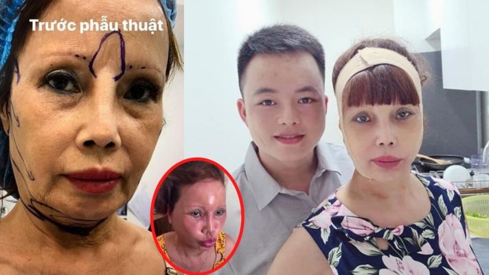 Hậu 'trùng tu nhan sắc', cô dâu 63 tuổi ở Cao Bằng gặp biến chứng phẫu thuật nặng nề