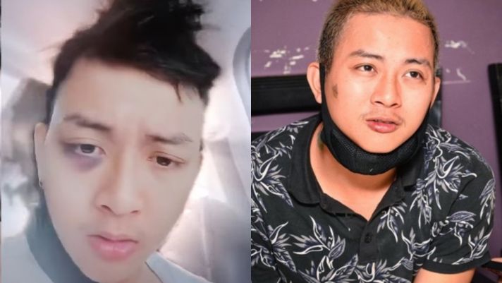 Clip Hoài Lâm bị thương bầm tím mắt, lộ biểu hiện tâm lý bất ổn sau khi báo tin buồn cho khán giả