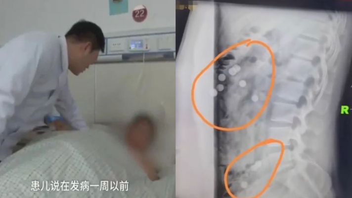 Chuyện lạ: Chàng trai đau thắt lưng, đi chụp X-quang phát hiện một bụng toàn trân châu