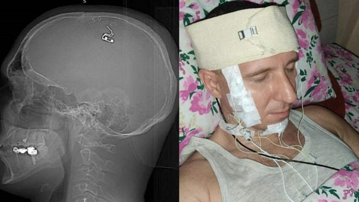 Danh tính người đàn ông tự phẫu thuật não ngay tại nhà riêng khiến giới y học ‘ngã ngửa’