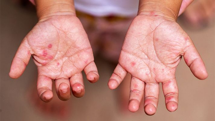 Việt Nam thử nghiệm thành công vaccine phòng tay chân miệng có hiệu quả tới 96,8%