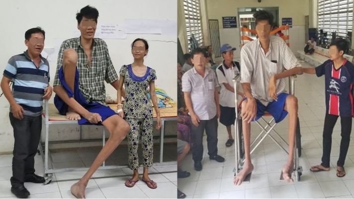 Người cao nhất lịch sử Việt Nam: Sở hữu số đo không tưởng, bất ngờ lý do khiến chiều cao bất thường