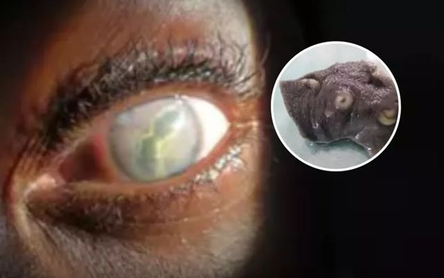Người phụ nữ kinh hoàng khi phát hiện ký sinh trùng 'giống giun' sống trong mắt suốt hai năm