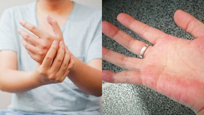 Nếu có 4 dấu hiệu ở lòng bàn tay này nghĩa là gan của bạn khỏe mạnh hơn những người cùng lứa tuổi
