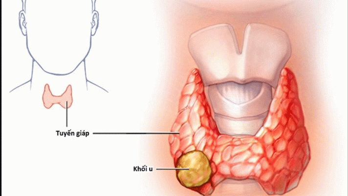 4 dấu hiệu sớm của ung thư tuyến giáp mà nhiều người thường hay bỏ qua?