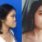 9x Phú Thọ 'đổi đời' sau 3 ca đại phẫu thay đổi hoàn toàn khuôn mặt