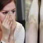 Khán giả xót xa khi nhìn thấy hình ảnh Lý Nhã Kỳ chằng chịt vết thương, vết bầm tím trên cơ thể