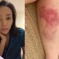 CĐM xót xa khi thấy chân dài từng được ông Đặng Lê Nguyên Vũ đưa đón chằng chịt vết bầm tím ở chân