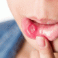 Đồng Tháp: Thanh niên 14 tuổi mắc HIV, 19 tuổi tá hỏa nhận kết quả nhiễm giang mai ác tính