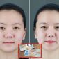 Phẫu thuật thẩm mỹ có phải làm lại Căn cước công dân gắn chip?