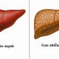 Tin cực vui cho người bị gan nhiễm mỡ: Phát minh ra loại chất ngăn chặn quá trình này