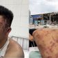 Nạn nhân vụ nổ lò hơi ở Đồng Nai ớn lạnh kể lại sự việc trước khi ngất xỉu, cận cảnh những vết thương