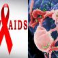 Nguyên nhân và triệu chứng của căn bệnh thế kỷ HIV mà bạn nên biết