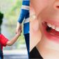 Bị bạn cùng lớp né tránh, nam học sinh tiểu học đẩy bạn ngã gãy răng khiến phụ huynh bức xúc