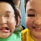 Bé trai 11 tuổi bỗng méo miệng sau một đêm: Bác sĩ tiết lộ nguyên nhân khiến nhiều phụ huynh giật mình