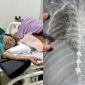 Tìm tài xế xe máy đâm bà lão ở Buôn Ma Thuột rồi bỏ trốn: Nạn nhân gãy 3 đốt sống, chưa có tiền phẫu thuật