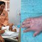 Hành trình phẫu thuật nối lại tay đứt lìa sau ghép tạm vào chân cho thai phụ: Bác sĩ thông tin tình trạng hiện tại